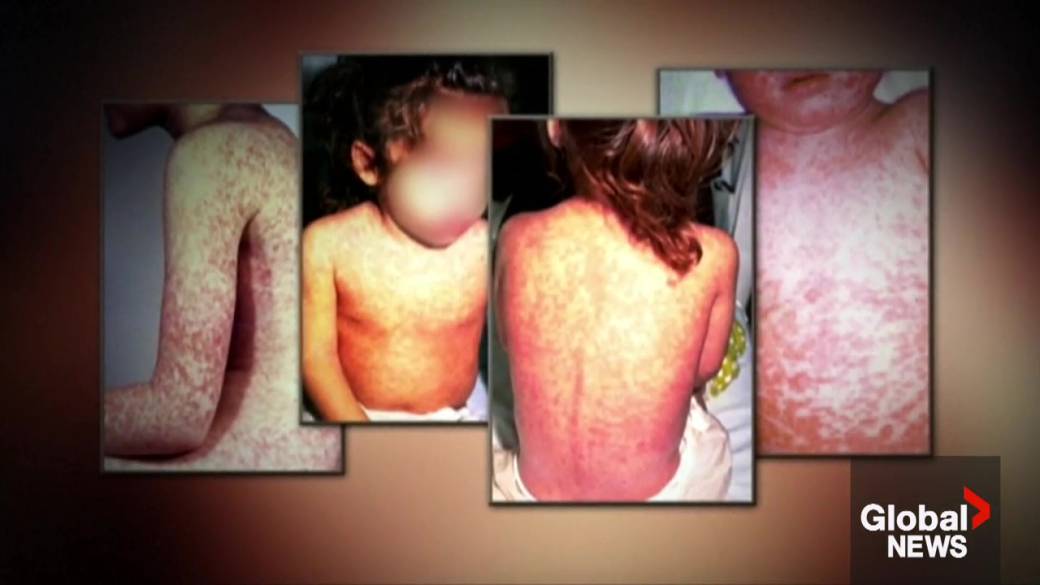 Click to play video: 'Alberta measles cases highest in 50 years'